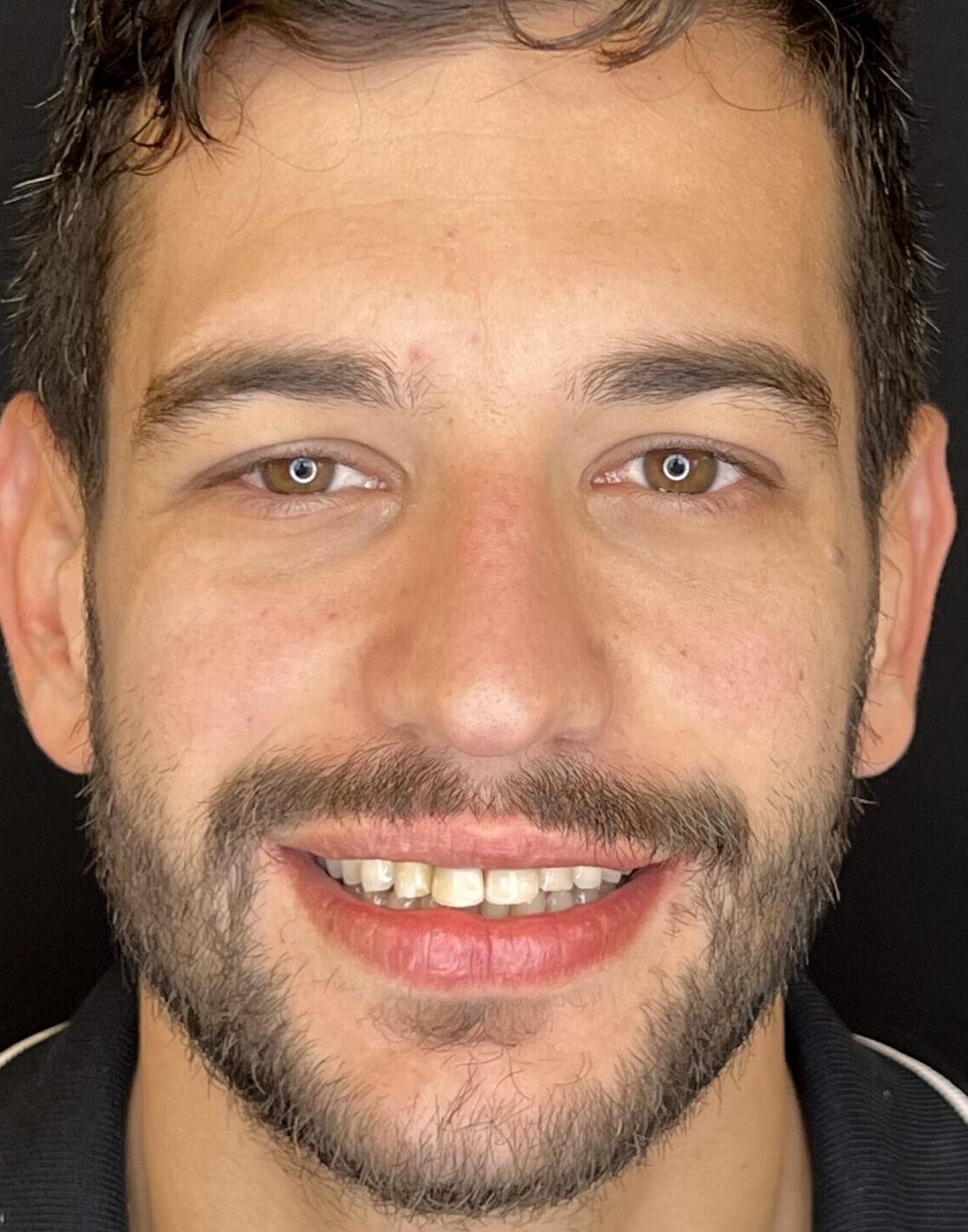 Antes Thiago (2) Antes Thiago (2)