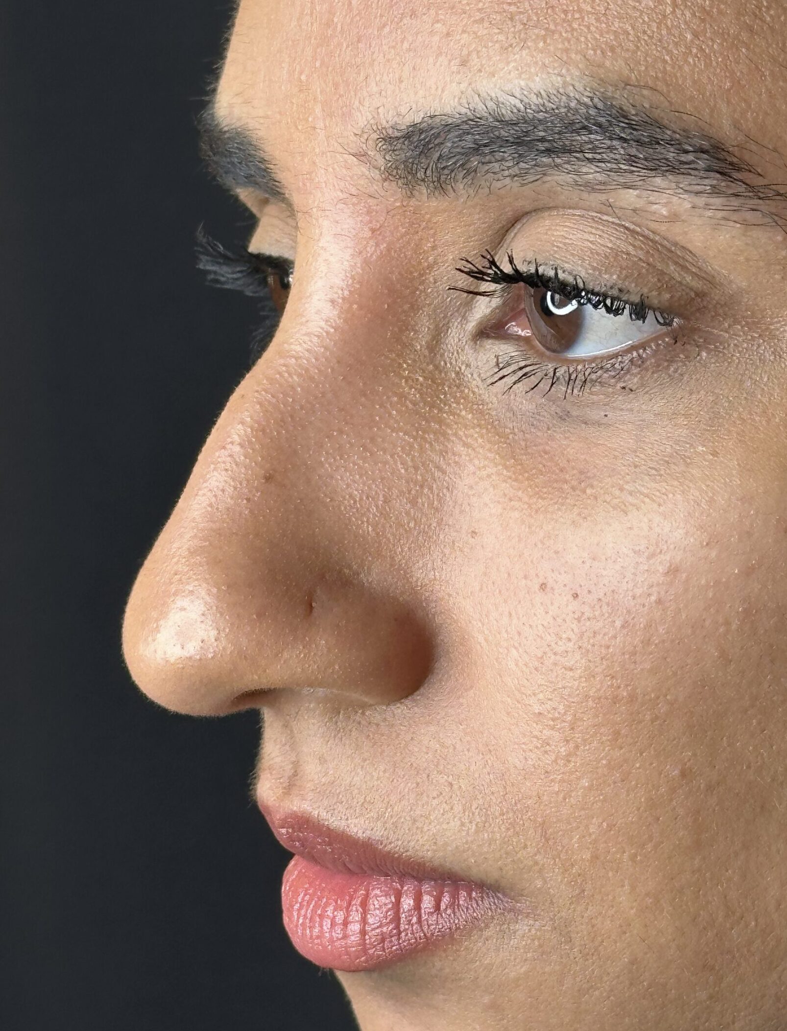 Harmonizacao Facial Antes