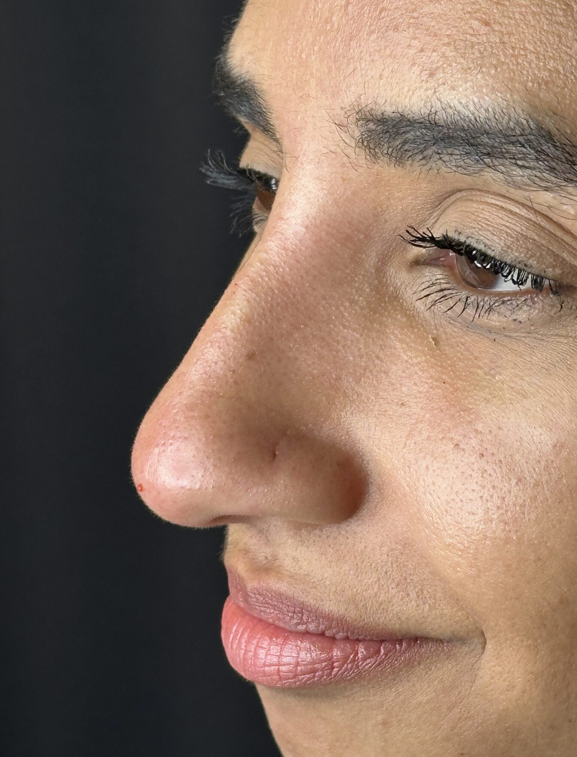 Harmonizacao Facial Depois